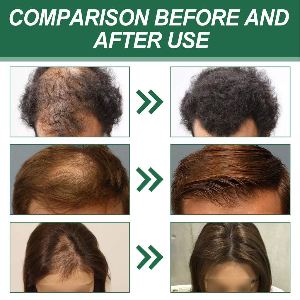 Hair Spray To Prevent Hair Loss, Moisturize, Strengthen And Thicken Hair And Scalp Massage Treatment Spray